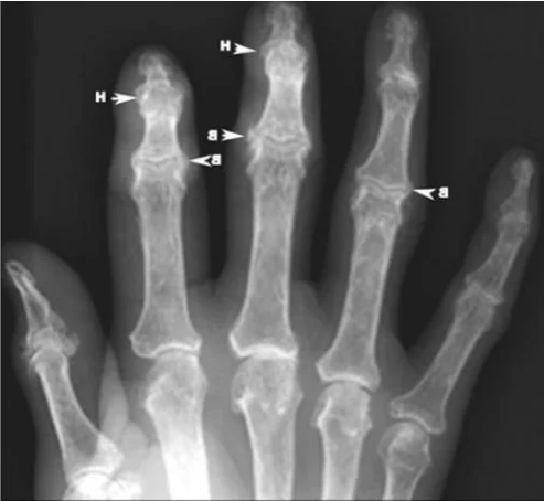 Osteófitos na osteoartrite das articulações dos dedos em um raio-x