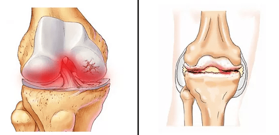 Comparação de artrose de artrite