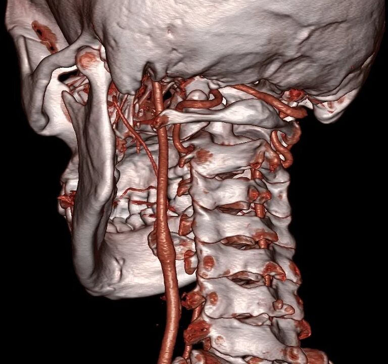 artéria comprimida com osteocondrose cervical