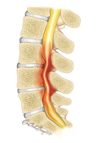Com osteocondrose da coluna torácica, ocorre compressão do canal espinhal