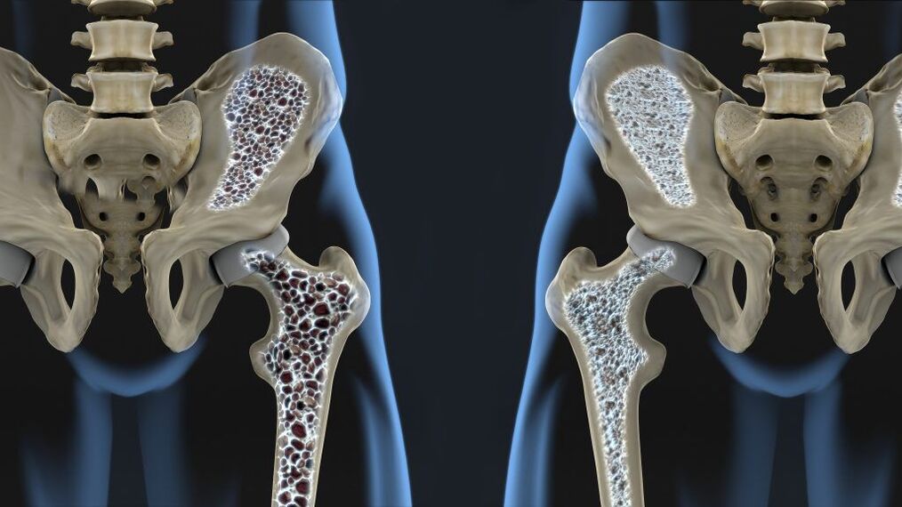 A osteoporose é a causa da fratura do quadril e artrose do quadril