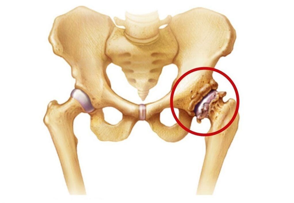 Articulação do quadril afetada por artrose