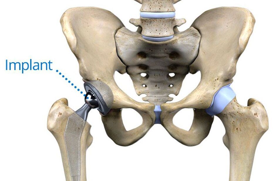 Artroplastia total do quadril para artrose