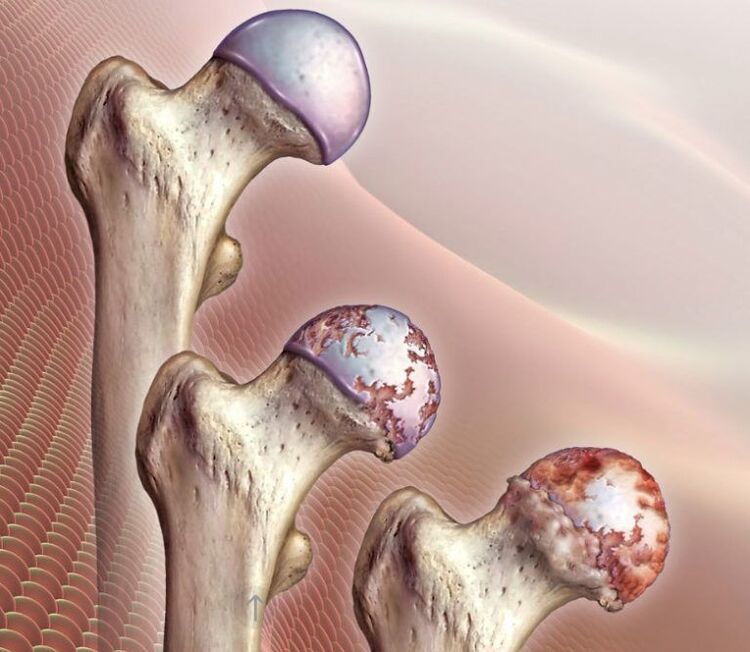 Artrose da articulação do quadril de vários graus