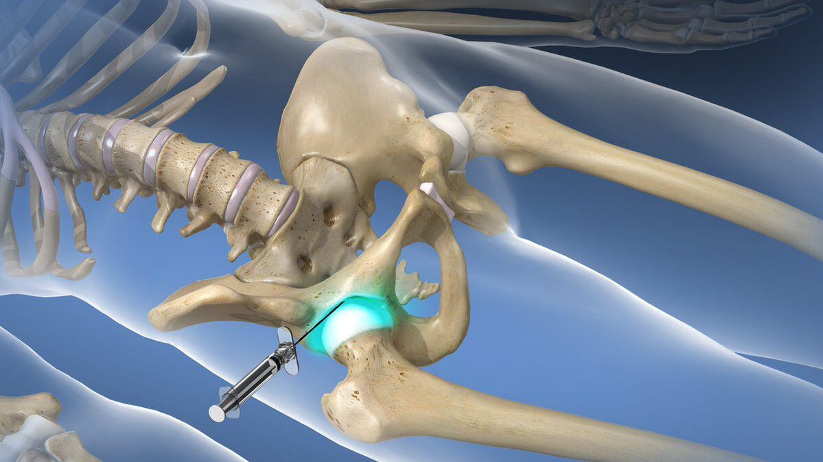 Bloqueio intra-articular para dor intensa que acompanha artrose do quadril