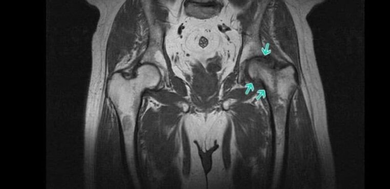 Osteoartrite da articulação do quadril na ressonância magnética