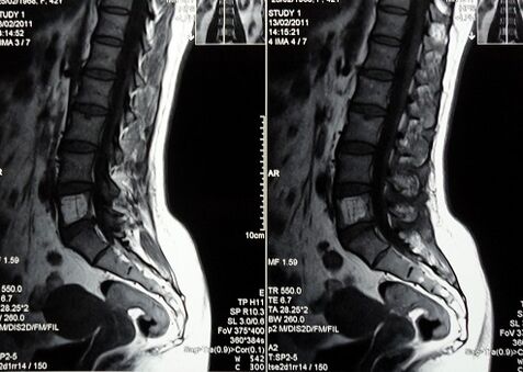 RM da coluna lombossacral para diagnosticar a dor lombar