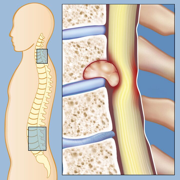 Tumor maligno como causa de dor lombar intensa